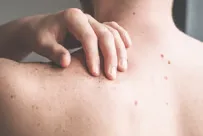 Câncer de pele: sinais e como se proteger